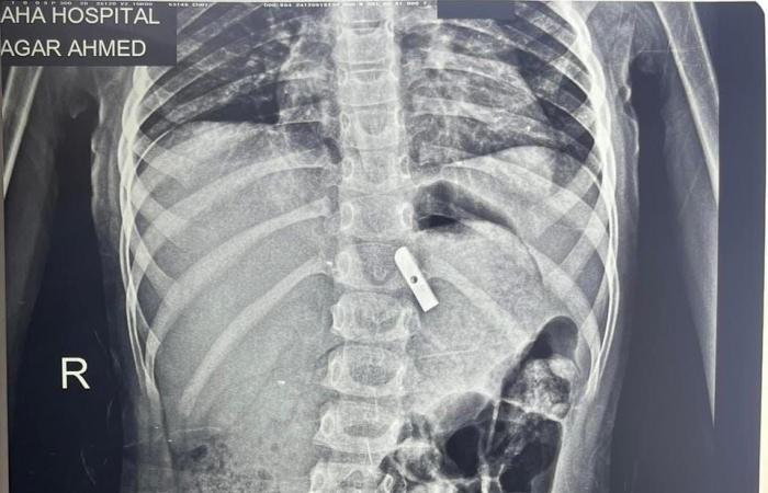 استخراج دبوس طرحة من صدر  طفلة بمستشفى بنها التخصصىى ..صور .. بوابة المساء الاخباري