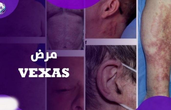 أول حالة في مصر.. إيه حكاية مرض VEXAS .. بوابة المساء الاخباري